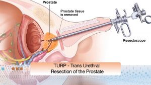turp