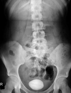X-Ray showimg Large Urinary Bladder Stone